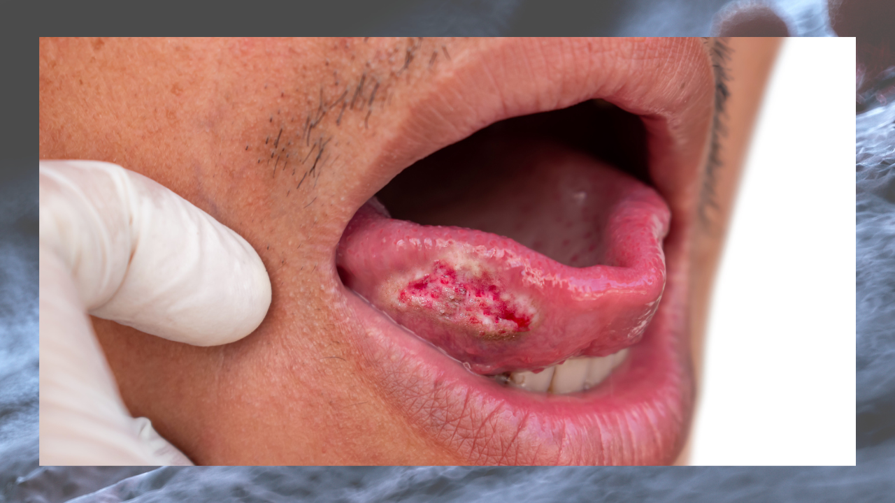 Symptoms of mouth cancer, Risk and Prevention Aurum Dentistry