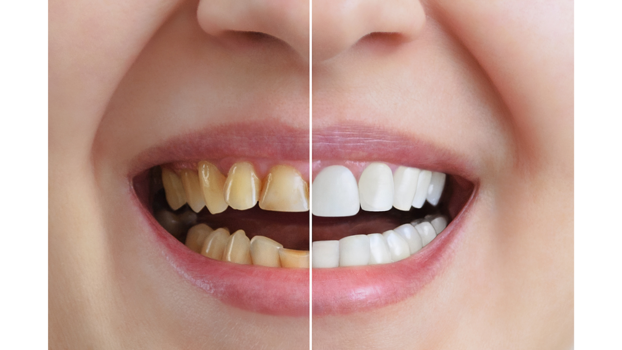 Top 10 Benefits of Dental Crowns Aurum Dentistry