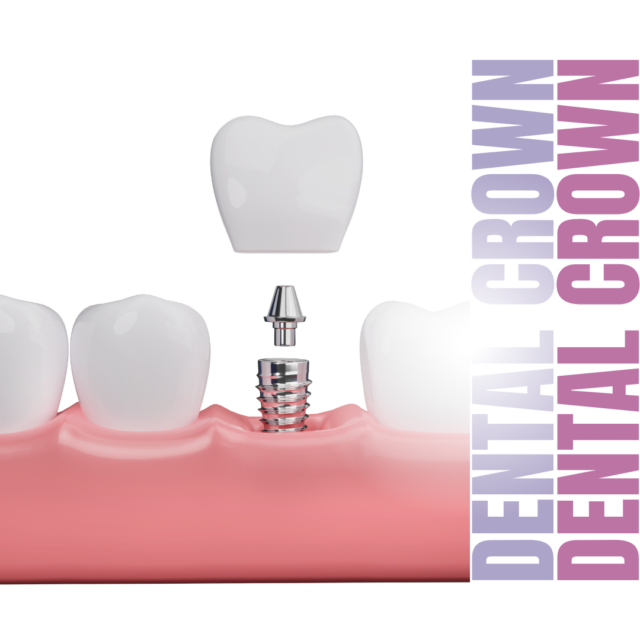 Dental Crowns