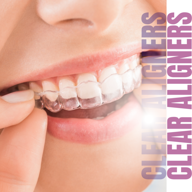 Clear Aligners
