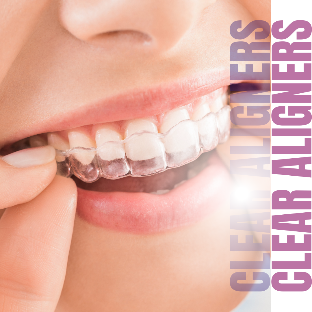 Clear Aligners or Invisible Braces Aurum Dentistry
